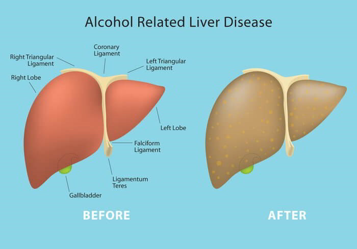 Alcohol Related Liver Disease and its Symptoms and Treatment - Earth's ...