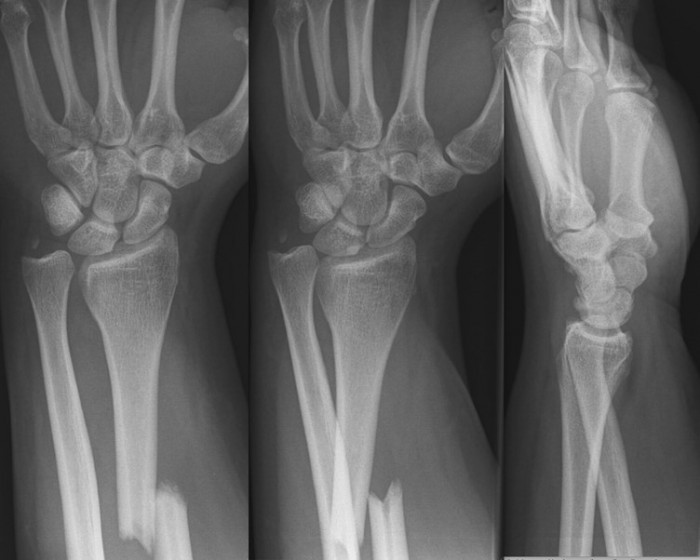 Fractures – Kinds, Symptoms and Treatment – Earth's Lab