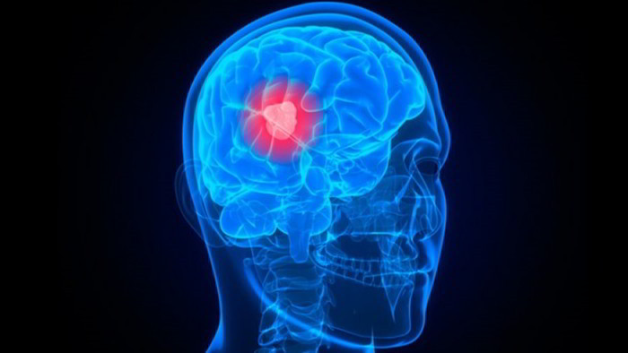 Brain Tumor Symptoms, Diagnosis and Treatment Earth's Lab