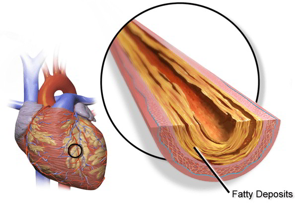 Coronary Artery Heart Disease (CHD) – Risk, Causes, Symptoms, Diagnosis ...