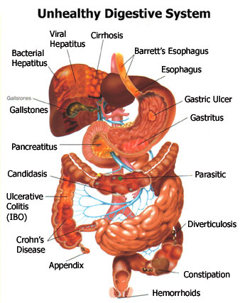 Disorders Of The Digestive System Earth S Lab   Digestion Related Disorders Graph 